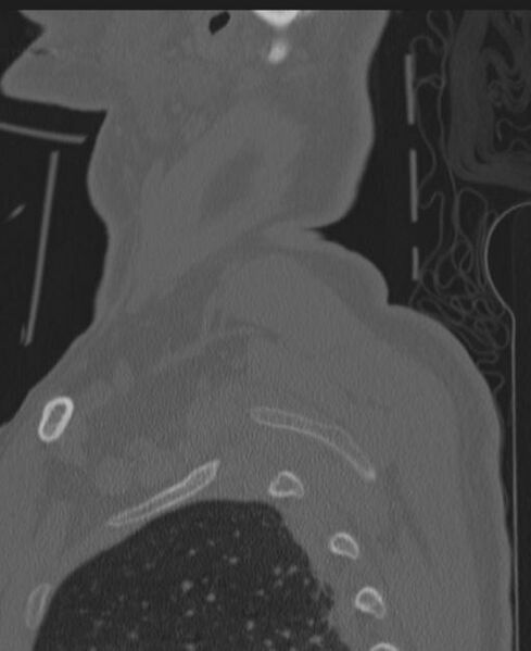 File:Cerebral hemorrhagic contusions and cervical spine fractures (Radiopaedia 32865-33841 Sagittal bone window 97).jpg