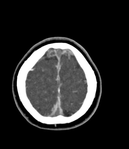 File:Cerebral venous sinus thrombosis (Radiopaedia 59224-66646 Axial C+ delayed 6).jpg