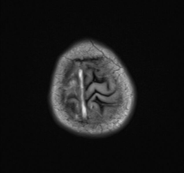 File:Cerebral venous thrombosis (Radiopaedia 71207-81504 Axial T1 23).jpg