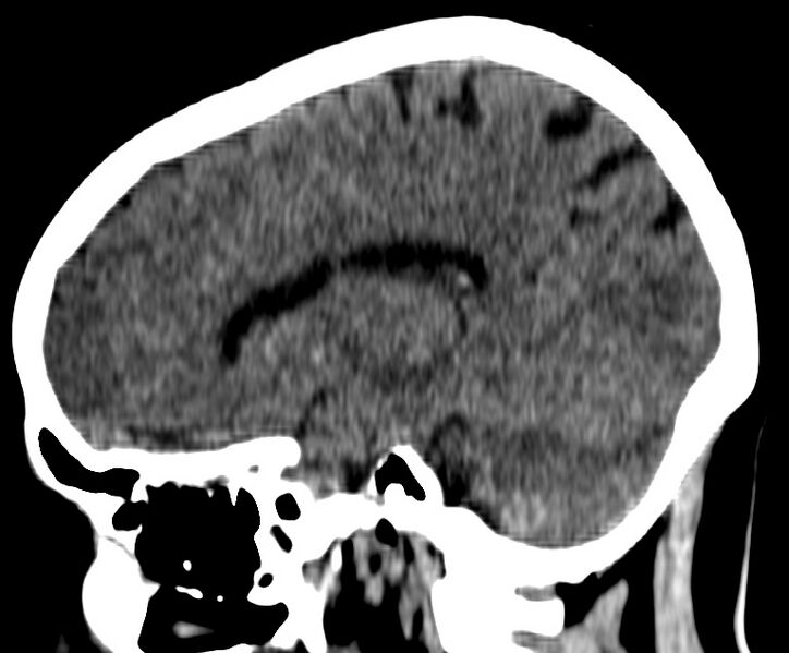 File:Cerebral venous thrombosis - CT only (Radiopaedia 41031-43778 B 11).jpg