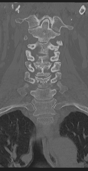 File:Cervical canal stenosis - OPLL and osteophytes (Radiopaedia 47329-51910 Coronal bone window 23).png