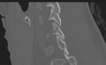 Cervical disc replacement (Radiopaedia 37383-39205 Sagittal bone window 27).png