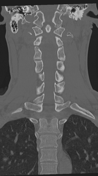 File:Cervical intercalary bone (Radiopaedia 35211-36748 Coronal bone window 43).png