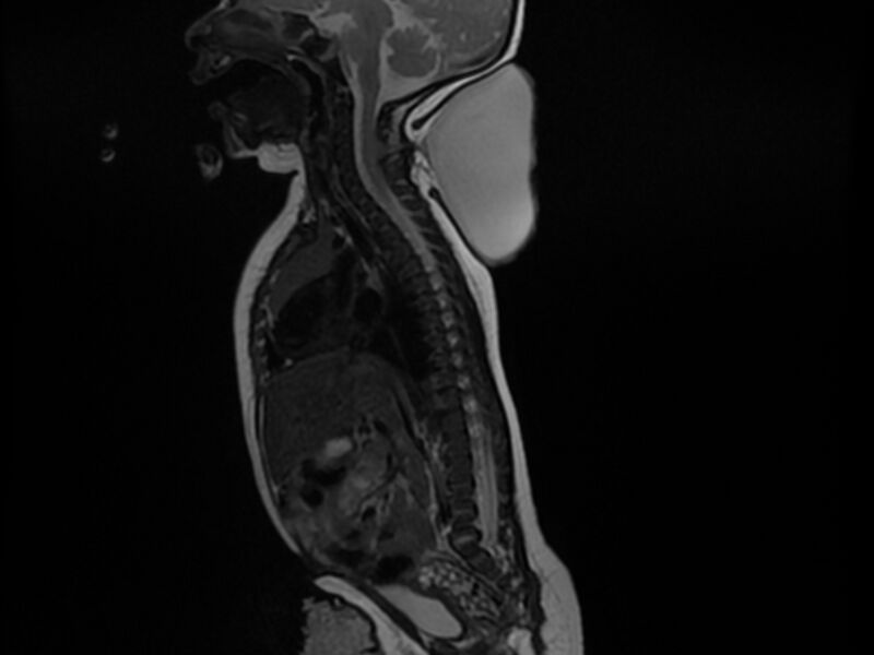 File:Cervical myelomeningocele (Radiopaedia 69569-79479 Sagittal T2 6).jpg
