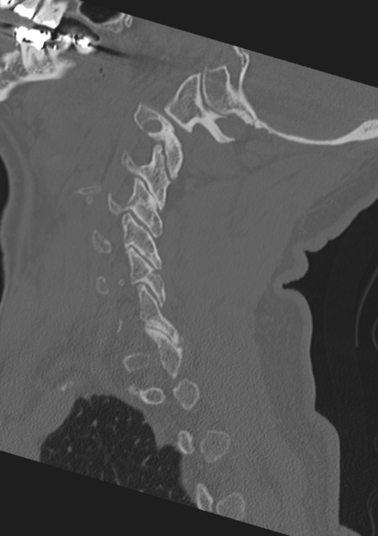 File:Cervical spine fractures with vertebral artery dissection (Radiopaedia 53296-59268 Sagittal bone window 49).png
