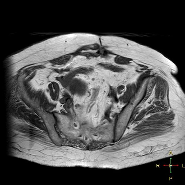 File:Cervical stump squamous cell carcinoma (Radiopaedia 48049-52858 Axial T1 15).jpg