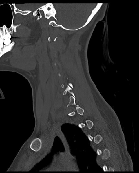 File:Cervical tuberculous spondylitis (Radiopaedia 39149-41365 Sagittal bone window 19).png