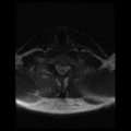 Cervical vertebrae metastasis (Radiopaedia 78814-91667 Axial T2 2).png