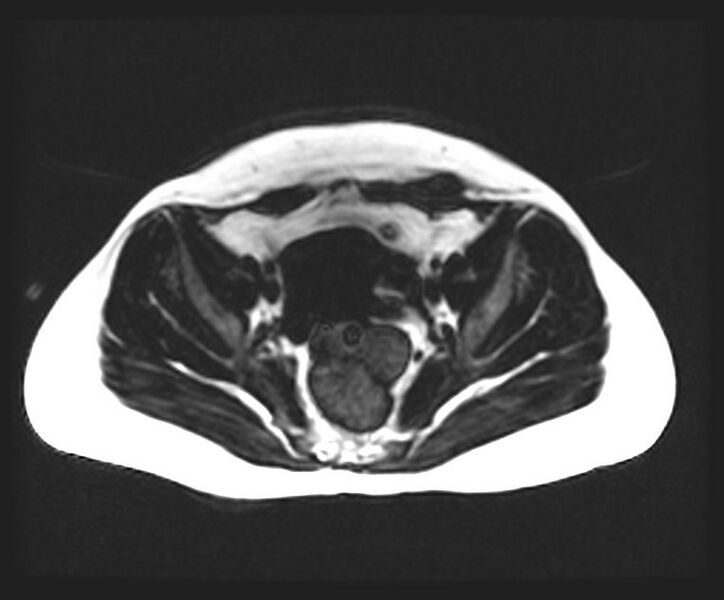 File:Cesarean section scar endometrioma (Radiopaedia 56569-63297 Axial T1 6).jpg