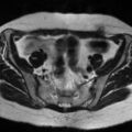 Cesarian section scar endometriosis (Radiopaedia 66520-75799 Axial T2 4).jpg
