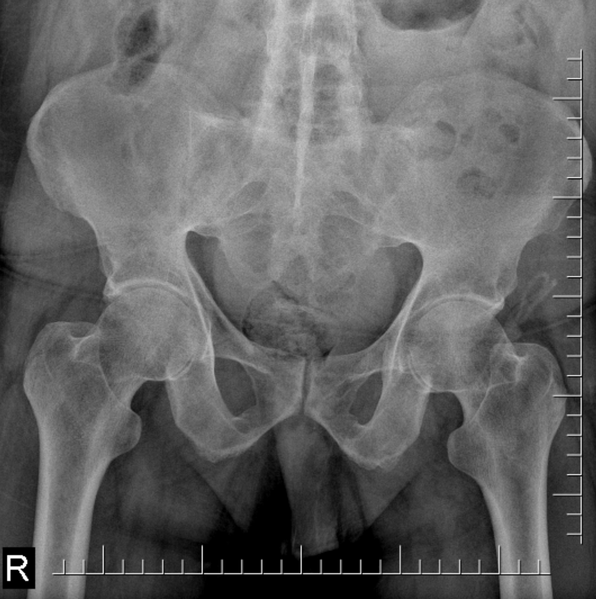File:Chalk stick fracture - ankylosing spondylitis (Radiopaedia 52572-58512 Frontal 1).png