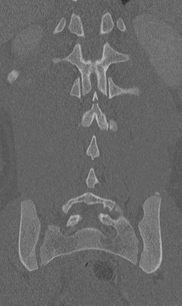 File:Chance fracture (Radiopaedia 40360-42912 Coronal bone window 50).png