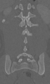 Chance fracture (Radiopaedia 40360-42912 Coronal bone window 50).png