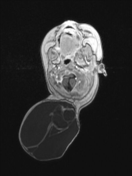 File:Chiari III malformation with occipital encephalocele (Radiopaedia 79446-92559 Axial T1 C+ mpr 29).jpg