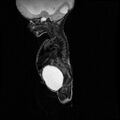 Chiari II malformation with spinal meningomyelocele (Radiopaedia 23550-23652 Sagittal T2 3).jpg