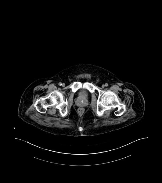 File:Cholangiocarcinoma with cerebral metastases (Radiopaedia 83519-98629 Axial non-contrast 124).jpg