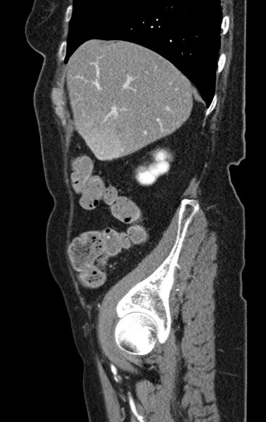 File:Cholecystoduodenal fistula due to calculous cholecystitis with gallstone migration (Radiopaedia 86875-103077 C 49).jpg