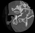 Cholesteatoma (Radiopaedia 20296-20217 bone window 11).jpg