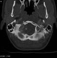 Chondroblastoma - occipital condyle (Radiopaedia 5569-7304 bone window 3).jpg