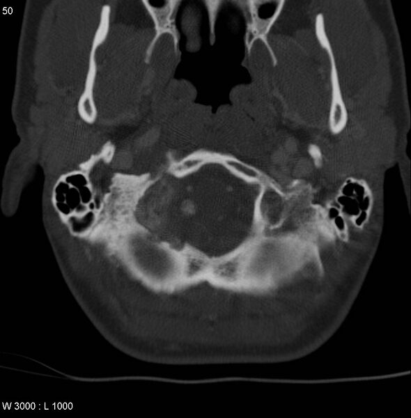 File:Chondroblastoma - occipital condyle (Radiopaedia 5569-7304 bone window 3).jpg