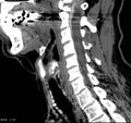 Chondrosarcoma - larynx (Radiopaedia 4588-6698 C 4).jpg