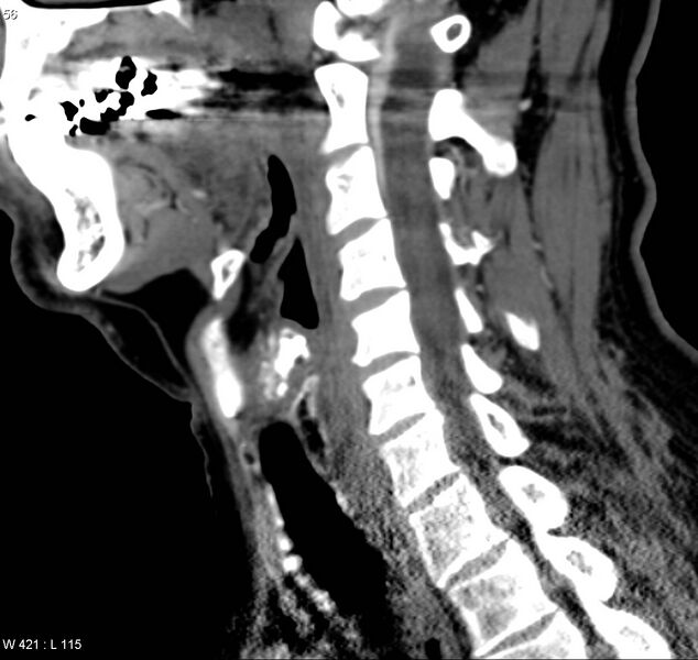 File:Chondrosarcoma - larynx (Radiopaedia 4588-6698 C 4).jpg