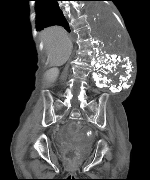 File:Chondrosarcoma of the spine (Radiopaedia 49871-55143 B 10).jpg