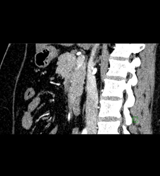 File:Chromophobe renal cell carcinoma (Radiopaedia 84286-99573 F 91).jpg