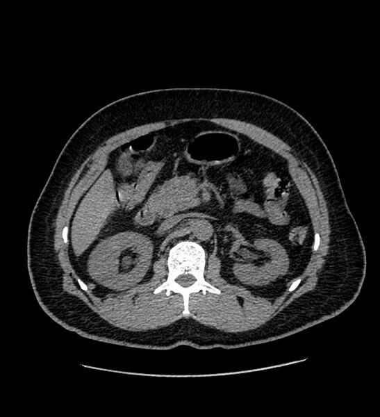 File:Chromophobe renal cell carcinoma (Radiopaedia 84337-99693 Axial non-contrast 48).jpg