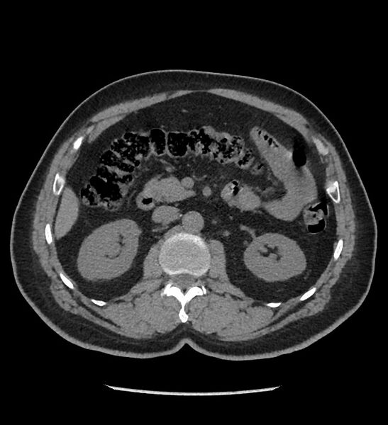 File:Chromophobe renal cell carcinoma (Radiopaedia 86879-103083 Axial non-contrast 38).jpg