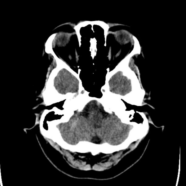 File:Chronic bilateral occipital lobe infarcts (Radiopaedia 31276-31996 Axial non-contrast 8).jpg