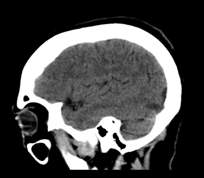 File:Chronic bilateral occipital lobe infarcts (Radiopaedia 31276-31996 C 11).jpg
