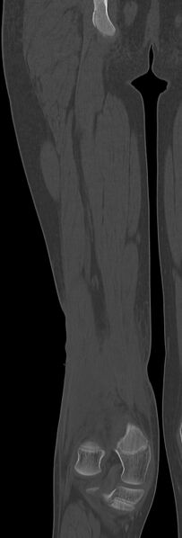 File:Chronic ostemyelitis of the femur with long sinus tract (Radiopaedia 74947-85982 Coronal bone window 56).jpg
