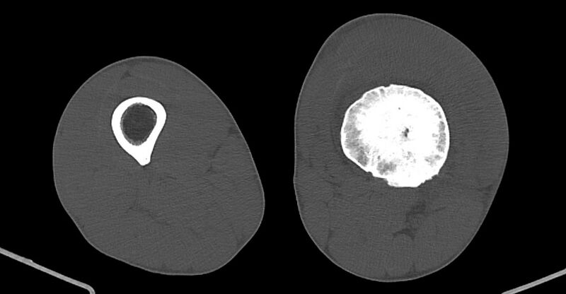 File:Chronic osteomyelitis (with sequestrum) (Radiopaedia 74813-85822 Axial non-contrast 129).jpg