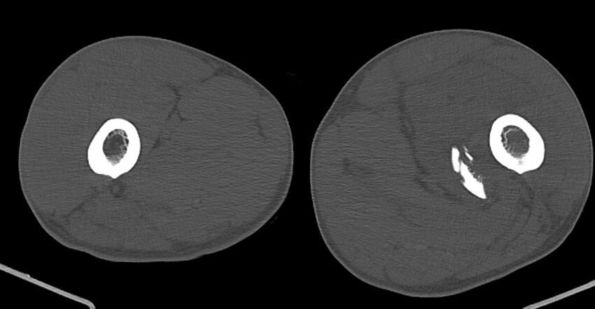 Chronic osteomyelitis (with sequestrum) (Radiopaedia 74813-85822 Axial non-contrast 76).jpg