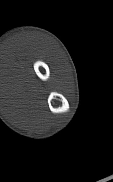 File:Chronic osteomyelitis of the distal humerus (Radiopaedia 78351-90971 Axial 86).jpg