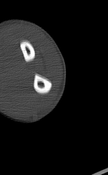 File:Chronic osteomyelitis of the distal humerus (Radiopaedia 78351-90971 Axial bone window 123).jpg