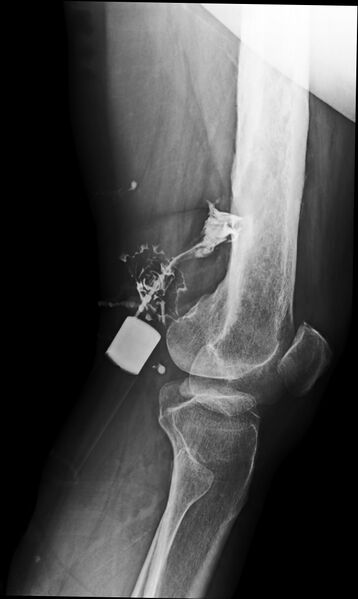 File:Chronic osteomyelitis of the right femur (Radiopaedia 78913-91802 Lateral 1).jpg