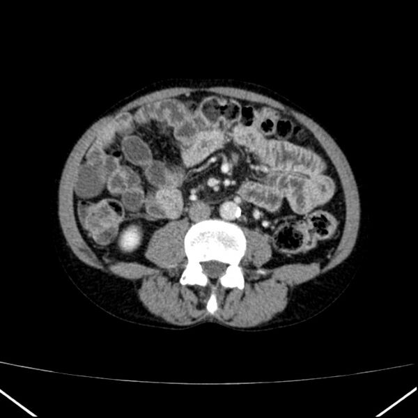 File:Chronic pancreatitis (Radiopaedia 23132-23172 B 36).jpg
