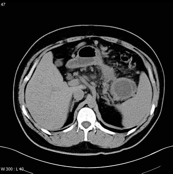 File:Chronic pancreatitis and pseudocysts (Radiopaedia 6724-7935 Axial non-contrast 4).jpg