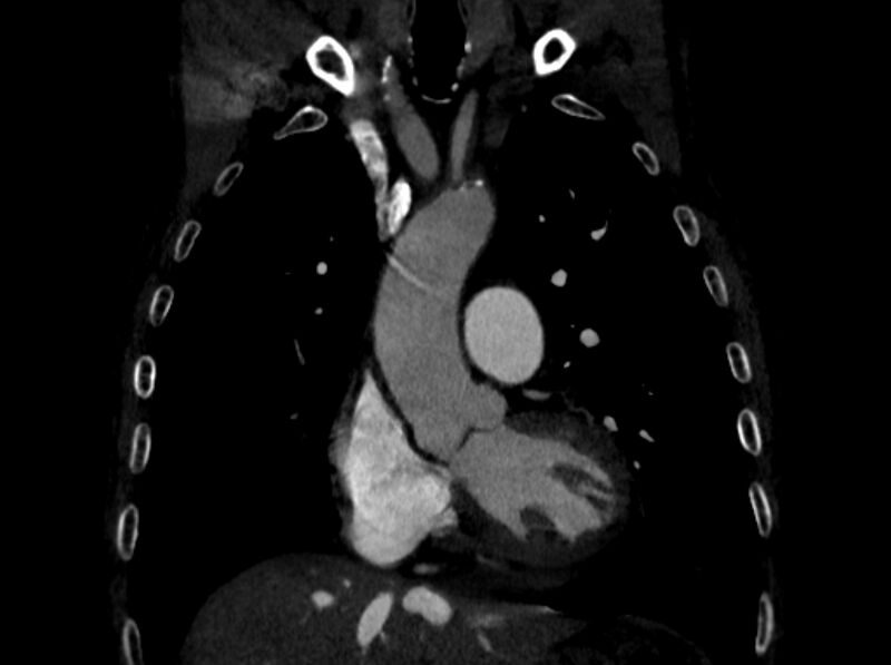 File:Chronic pulmonary embolism (Radiopaedia 91241-108843 A 35).jpg