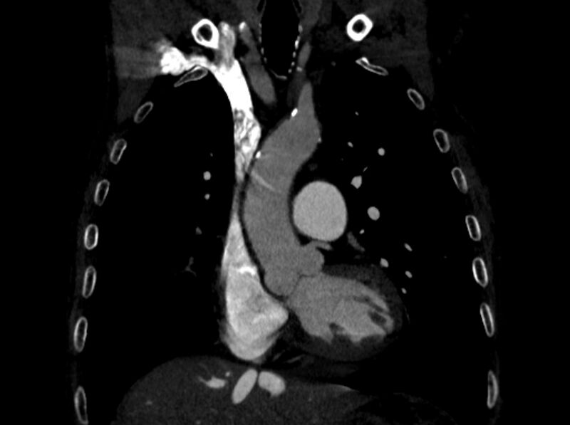 File:Chronic pulmonary embolism (Radiopaedia 91241-108843 A 38).jpg
