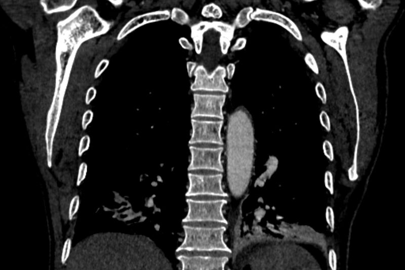File:Chronic pulmonary embolism with bubbly consolidation (Radiopaedia 91248-108850 B 107).jpg