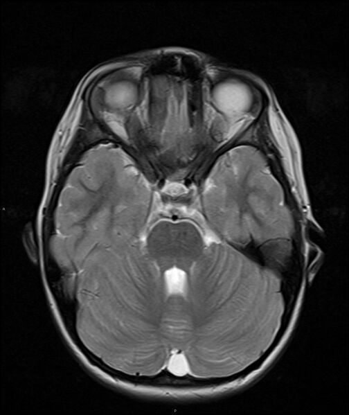 File:Chronic reactive multifocal osteomyelitis (CRMO) - mandible (Radiopaedia 56405-63069 Axial T2 26).jpg