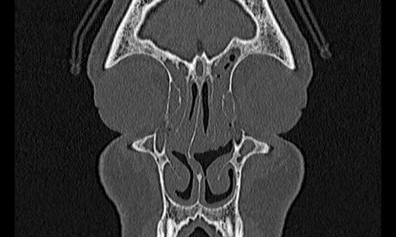 File:Chronic rhinosinusitis (Radiopaedia 65079-74075 Coronal bone window 15).jpg