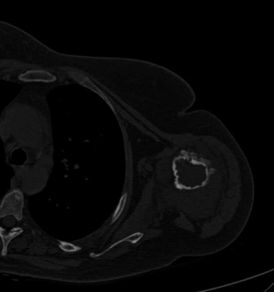 File:Clear cell chondrosarcoma - humerus (Radiopaedia 63104-71612 Axial bone window 61).jpg