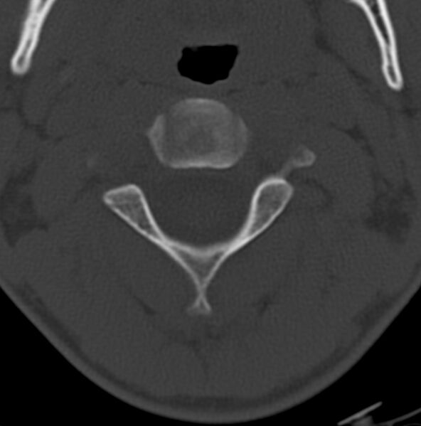 File:Cleft of the posterior arch of C1 mimicking fracture (Radiopaedia 40201-42721 Axial bone window 7).jpg