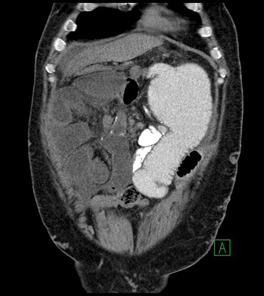 File:Closed-loop small bowel obstruction-internal hernia (Radiopaedia 78439-91096 Coronal non-contrast 28).jpg