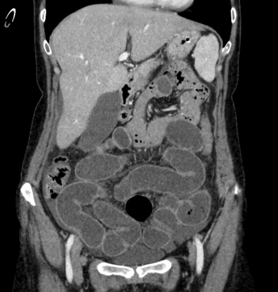 File:Closed loop small bowel obstruction (Radiopaedia 71211-81508 B 29).jpg