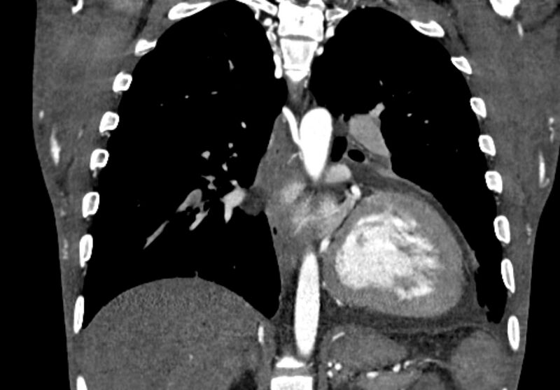 File:Coarctation of aorta with aortic valve stenosis (Radiopaedia 70463-80574 C 155).jpg